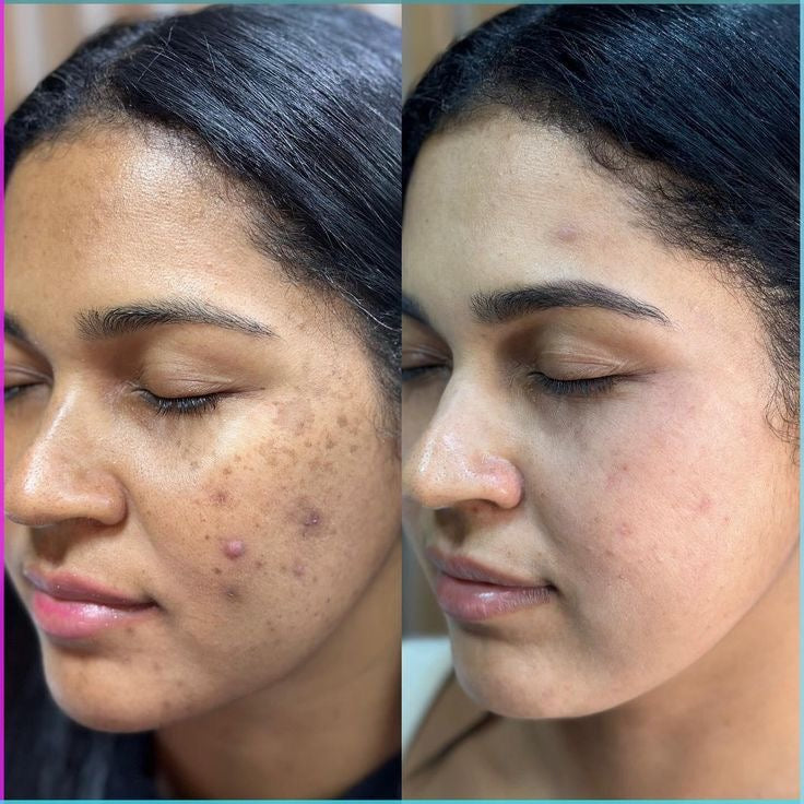 Mylkya Purlychee – Clear Skin Formula