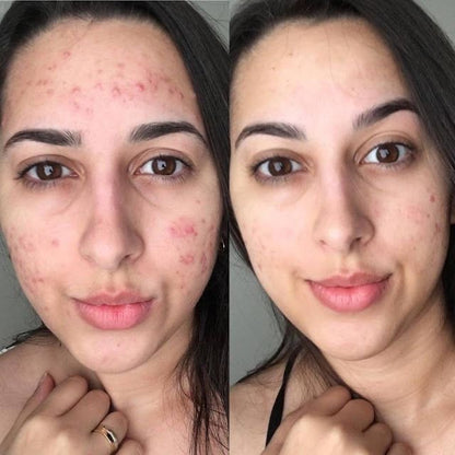 Mylkya Purlychee – Clear Skin Formula